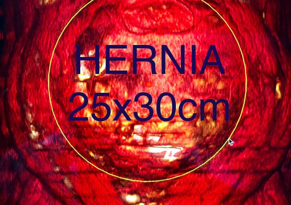 foto cirugía de hernia ventral