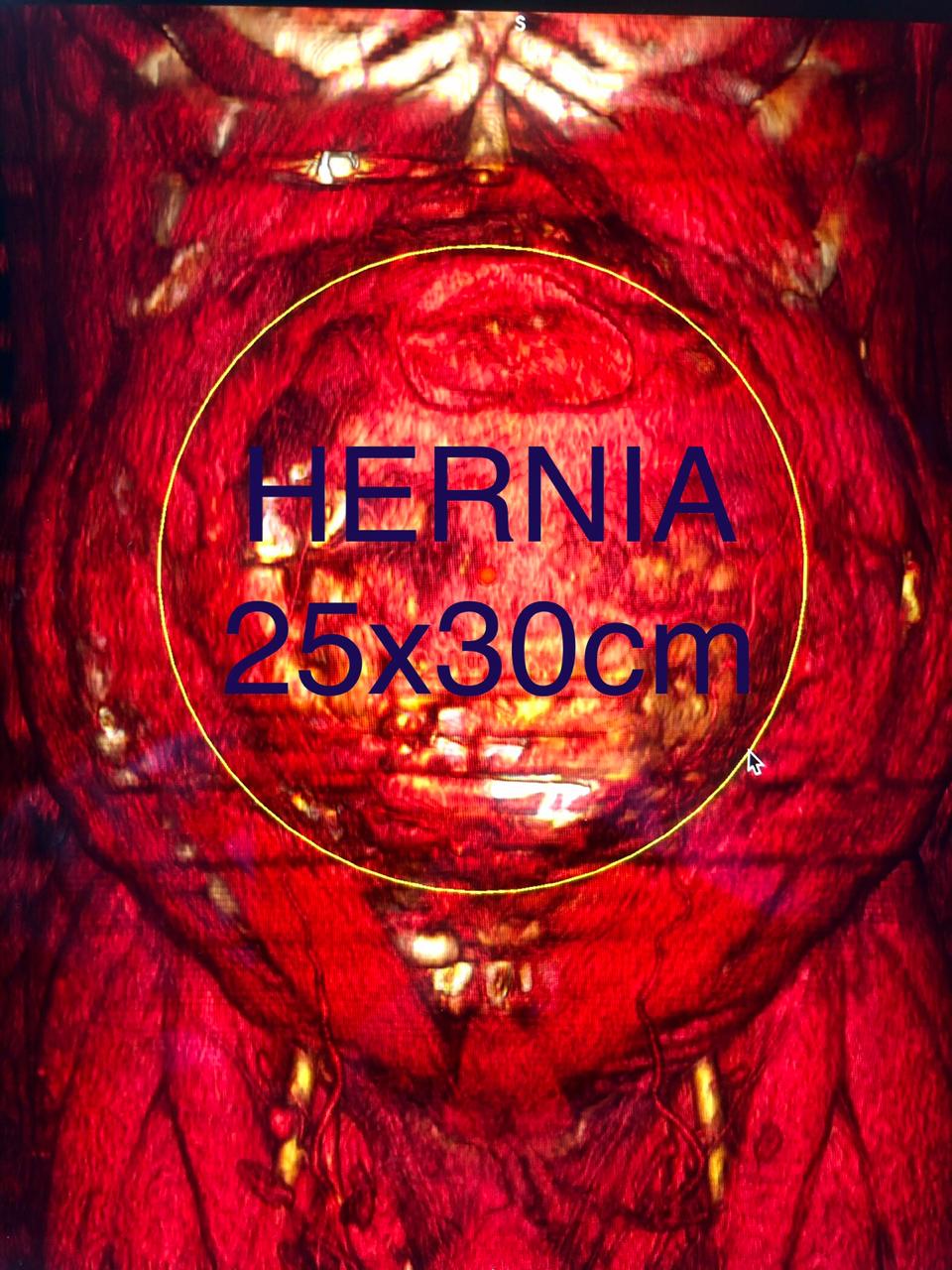 foto cirugía de hernia ventral