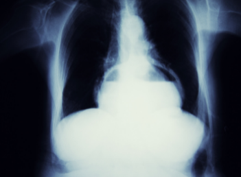 medico hernias inguinales medico hernias inguinales