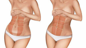 diastasis de rectos antes y después