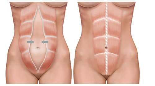 diastasis de rectos antes y después