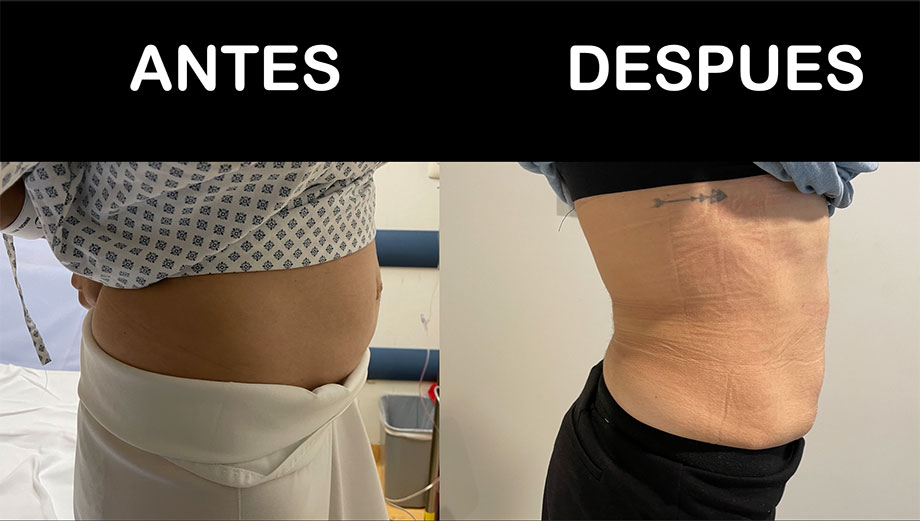 doctor hernia diastasis de rectos pared abdominal