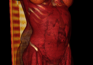 Hernia Ventral
