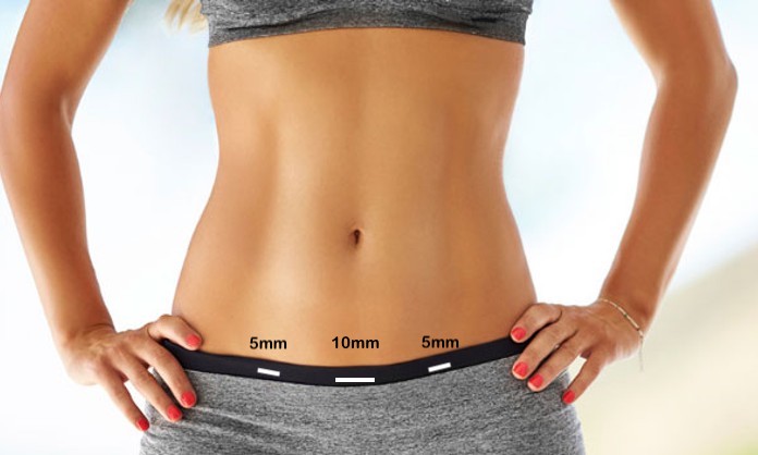 Abdominoplastia Laparoscopica en Guadalajara